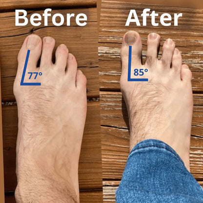 FlexiToes - Natural Toe Aligners